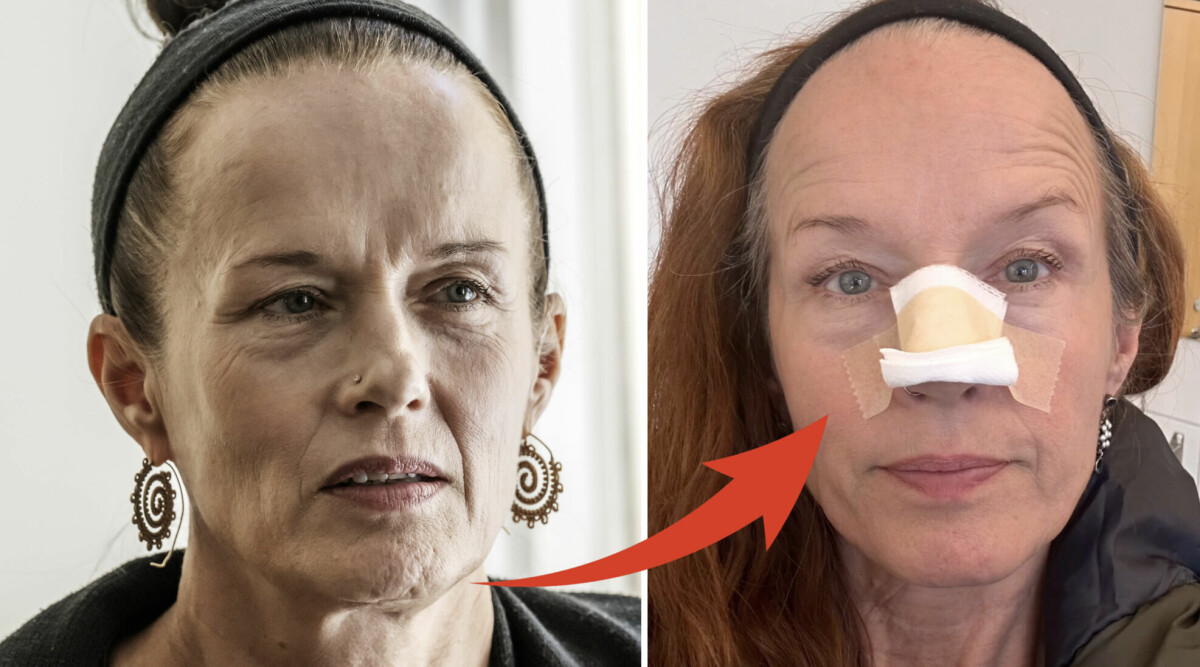 Malin Berghagen, 59, inte nöjd med näsan – fixat till den