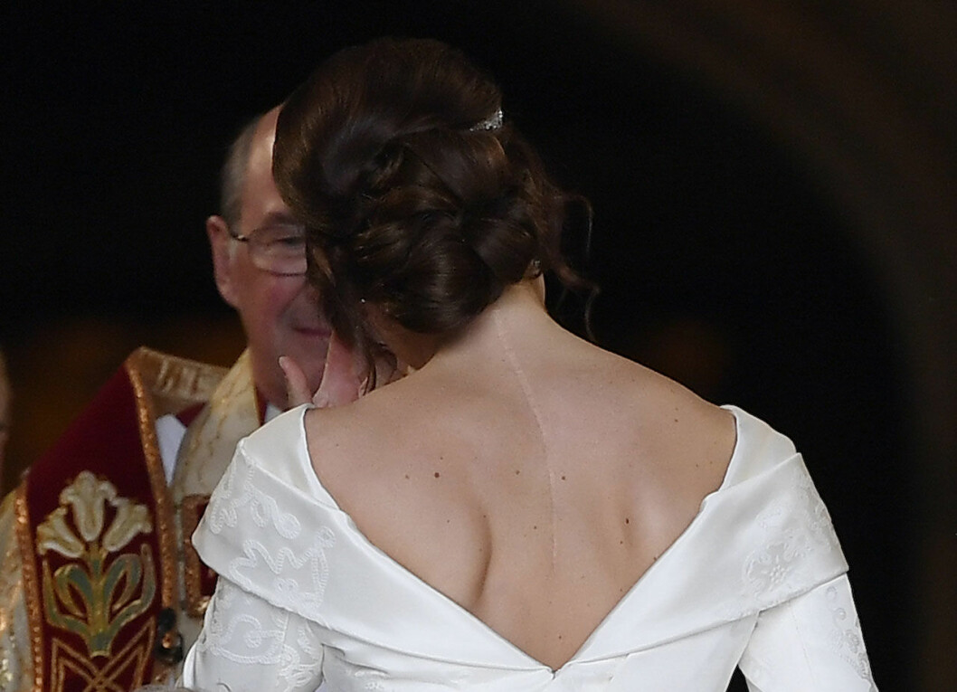 När prinsessan Eugenie gifte sig 2018 valde hon en klänning där hennes ärr syntes tydligt. Prinsessan Eugenie