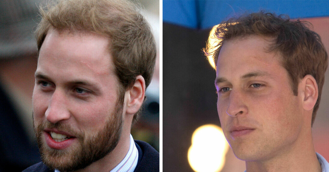Prinsens ärr är nästan på samma ställe som fruns. Prins William