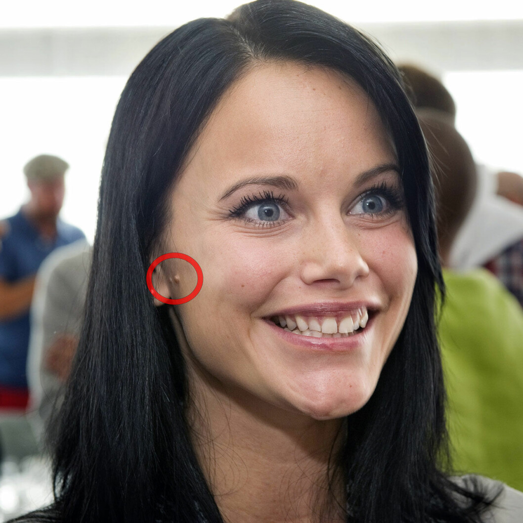 Prinsessan Sofia hösten 2011. Prinsessan Sofias födelsemärken
